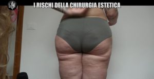 iene-danni-chirurgia-estetica-6